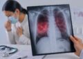 La tuberculosis es curable si se detecta y trata oportunamente
