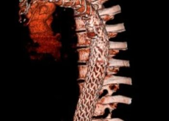 Realiza Hospital “Elvia Carrillo Puerto” del ISSSTE en Mérida cirugías de aorta con técnica Trompa de Elefante Congelada
